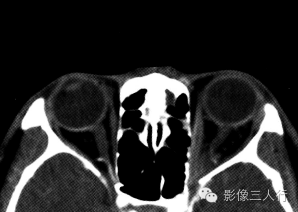 【病例】甲状腺相关性眼病1例CT影像表现分析 【病例】甲状腺相关性眼病1例CT影像表现分析
