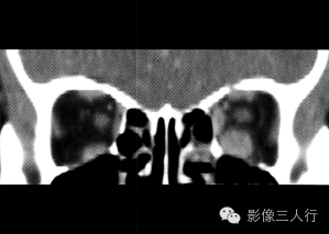 【病例】甲状腺相关性眼病1例CT影像表现分析
