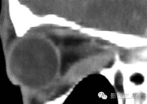 【病例】甲状腺相关性眼病1例CT影像表现分析 【病例】甲状腺相关性眼病1例CT影像表现分析