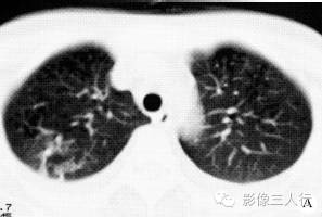 【病例】两上肺肺吸虫感染1例CT影像表现分析 【病例】两上肺肺吸虫感染1例CT影像表现分析