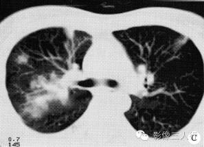 【病例】两上肺肺吸虫感染1例CT影像表现分析 【病例】两上肺肺吸虫感染1例CT影像表现分析