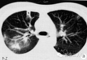 【病例】两上肺肺吸虫感染1例CT影像表现分析