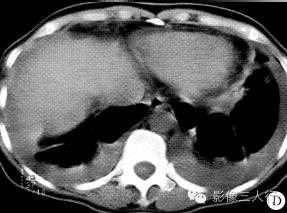 【病例】两上肺肺吸虫感染1例CT影像表现分析 【病例】两上肺肺吸虫感染1例CT影像表现分析