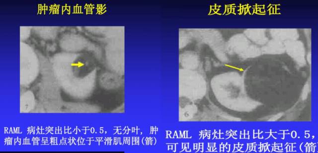 我读你看系列——肾细胞癌篇 我读你看系列——肾细胞癌篇