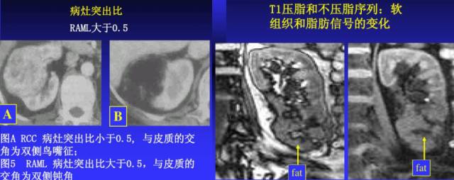 我读你看系列——肾细胞癌篇 我读你看系列——肾细胞癌篇