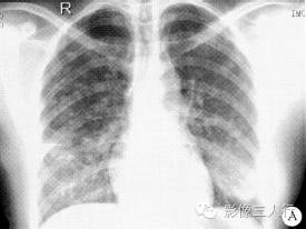 【病例】肺郎汉斯组织细胞增生症1例CT影像表现