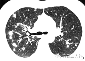 【病例】肺郎汉斯组织细胞增生症1例CT影像表现