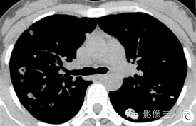 【病例】肺郎汉斯组织细胞增生症1例CT影像表现