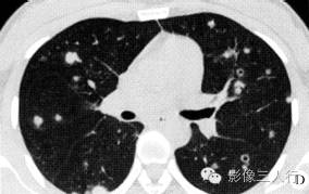 【病例】肺郎汉斯组织细胞增生症1例CT影像表现