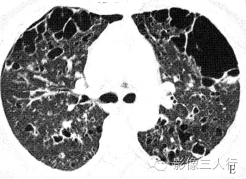【病例】肺郎汉斯组织细胞增生症1例CT影像表现