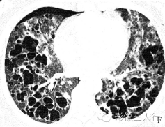 【病例】肺郎汉斯组织细胞增生症1例CT影像表现