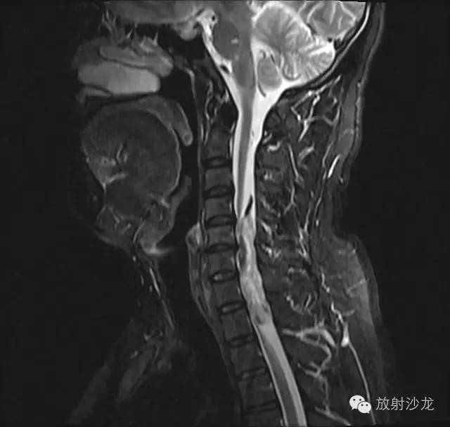 【病例】椎管内神经鞘瘤1例MR影像表现