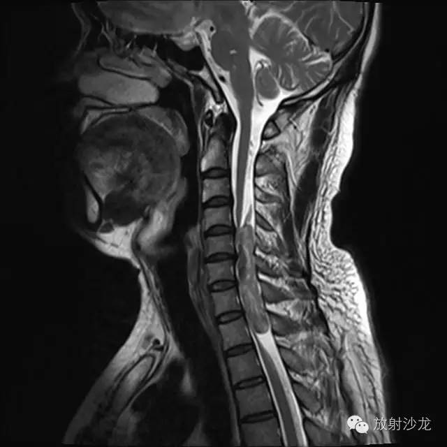 【病例】椎管内神经鞘瘤1例MR影像表现 【病例】椎管内神经鞘瘤1例MR影像表现