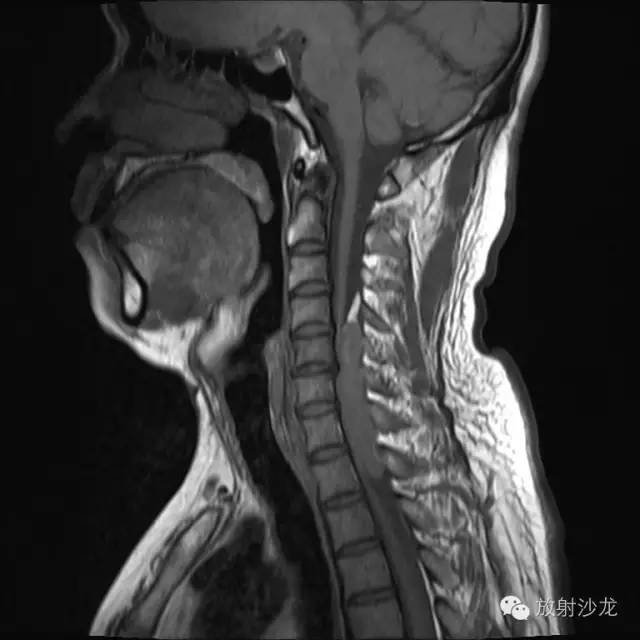 【病例】椎管内神经鞘瘤1例MR影像表现 【病例】椎管内神经鞘瘤1例MR影像表现