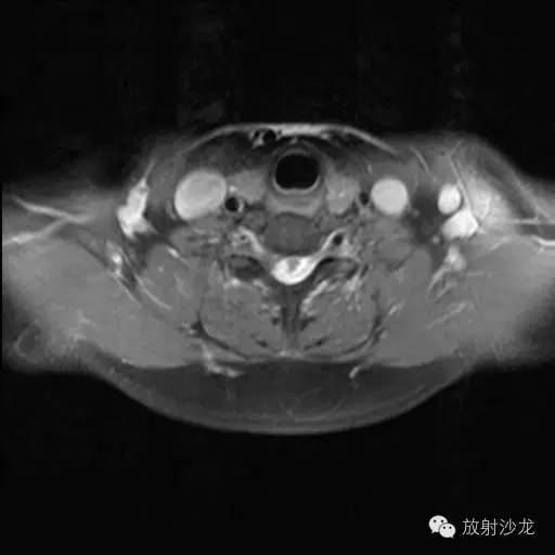【病例】椎管内神经鞘瘤1例MR影像表现 【病例】椎管内神经鞘瘤1例MR影像表现