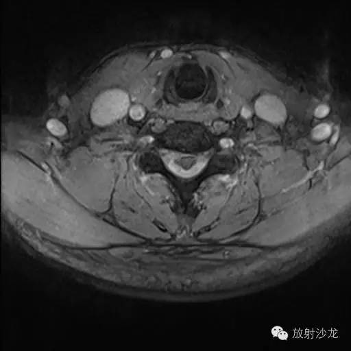 【病例】椎管内神经鞘瘤1例MR影像表现 【病例】椎管内神经鞘瘤1例MR影像表现
