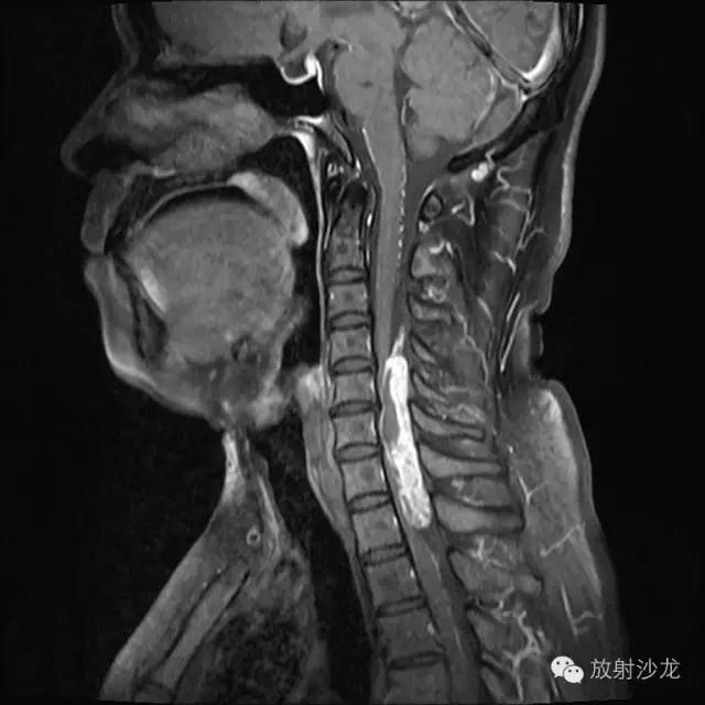 【病例】椎管内神经鞘瘤1例MR影像表现 【病例】椎管内神经鞘瘤1例MR影像表现