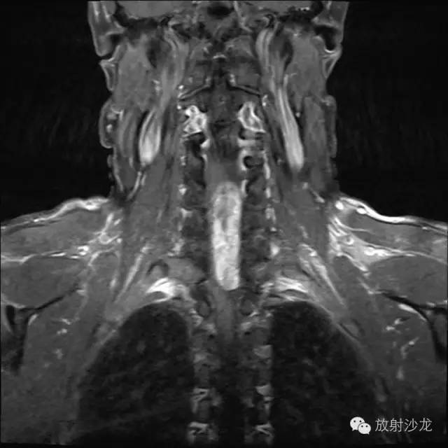 【病例】椎管内神经鞘瘤1例MR影像表现 【病例】椎管内神经鞘瘤1例MR影像表现