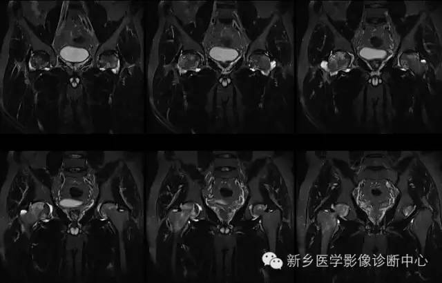 股骨头坏死的程度和骨髓水肿有关系吗？答案也许是否定的！