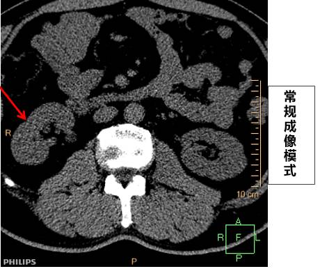 显微CT检出肾微小结石:“再小,你也跑不了”! 显微CT检出肾微小结石:“再小,你也跑不了”!