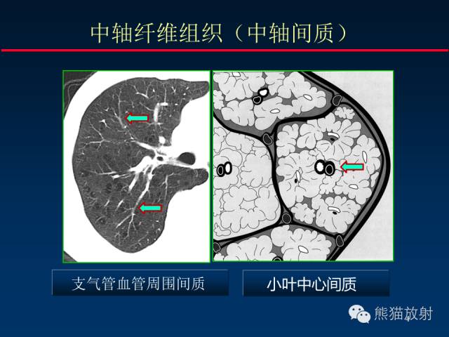 【PPT】肺内间质改变的基本CT征象