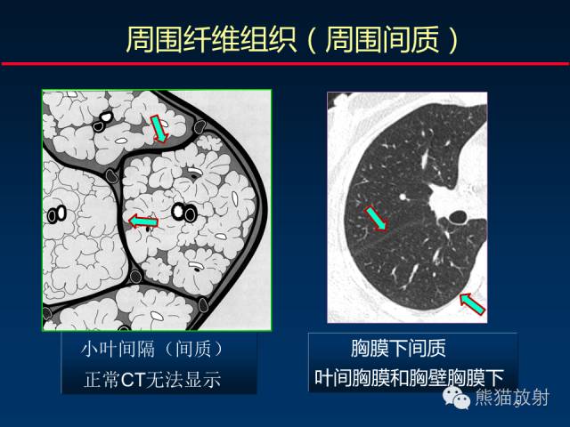 【PPT】肺内间质改变的基本CT征象