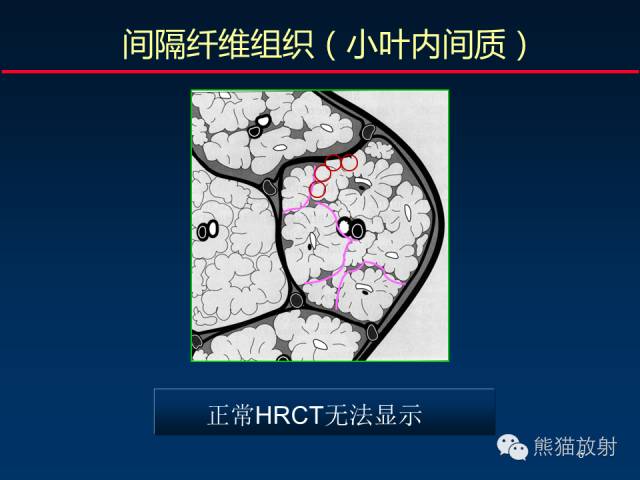 【PPT】肺内间质改变的基本CT征象