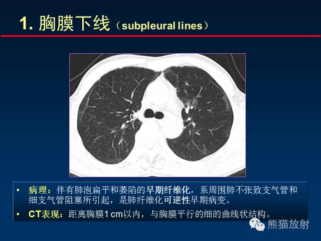 【PPT】肺内间质改变的基本CT征象