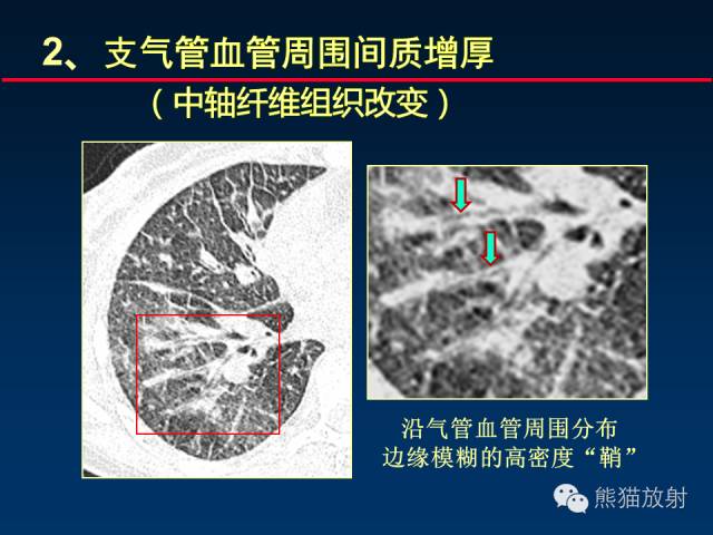 【PPT】肺内间质改变的基本CT征象