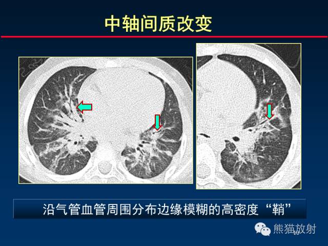 【PPT】肺内间质改变的基本CT征象