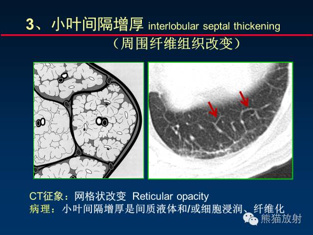 【PPT】肺内间质改变的基本CT征象