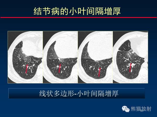 【PPT】肺内间质改变的基本CT征象
