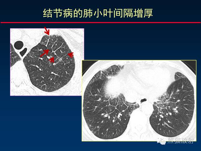 【PPT】肺内间质改变的基本CT征象