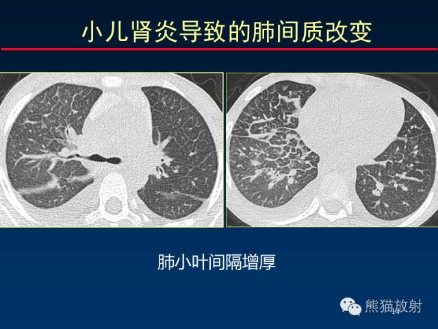【PPT】肺内间质改变的基本CT征象