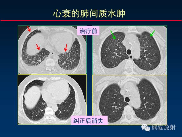 【PPT】肺内间质改变的基本CT征象