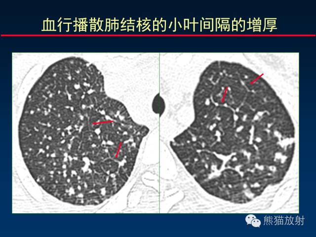 【PPT】肺内间质改变的基本CT征象
