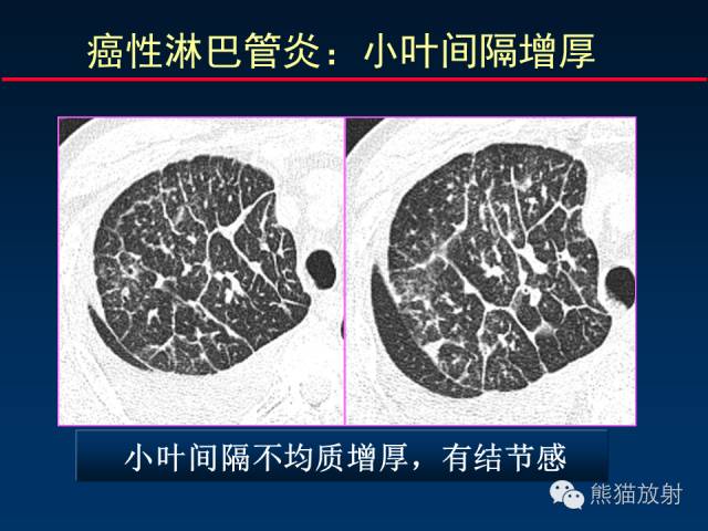 【PPT】肺内间质改变的基本CT征象