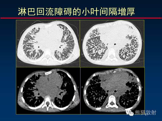 【PPT】肺内间质改变的基本CT征象