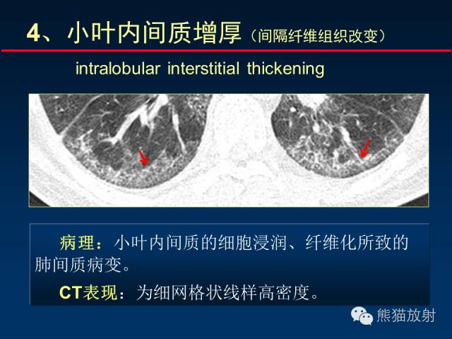 【PPT】肺内间质改变的基本CT征象