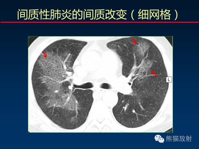【PPT】肺内间质改变的基本CT征象