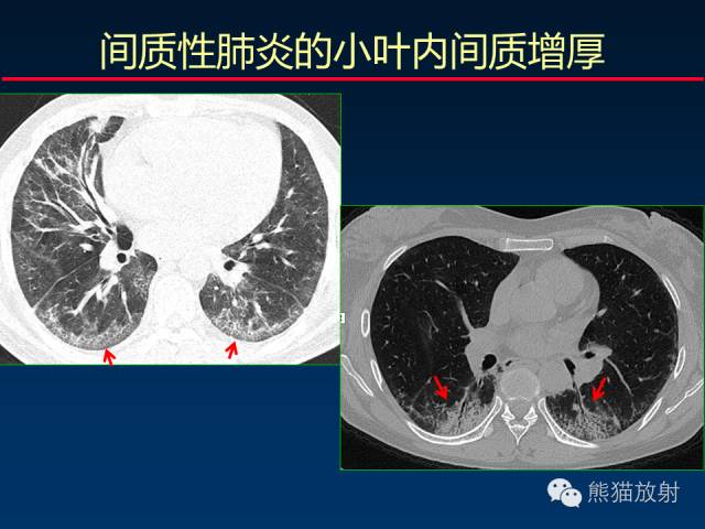 【PPT】肺内间质改变的基本CT征象