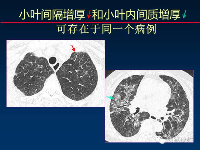 【PPT】肺内间质改变的基本CT征象