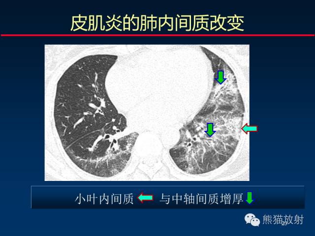 【PPT】肺内间质改变的基本CT征象