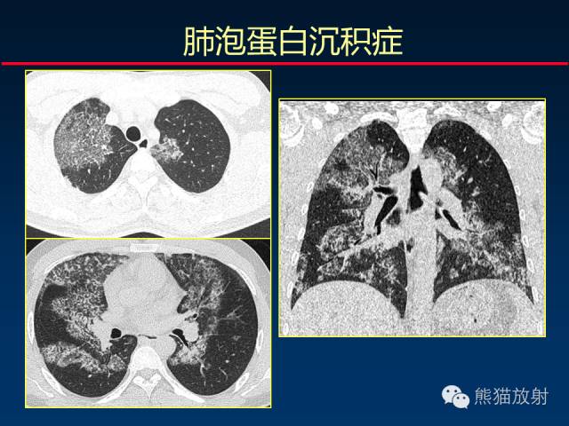 【PPT】肺内间质改变的基本CT征象