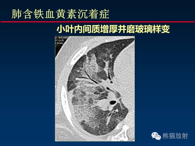 【PPT】肺内间质改变的基本CT征象