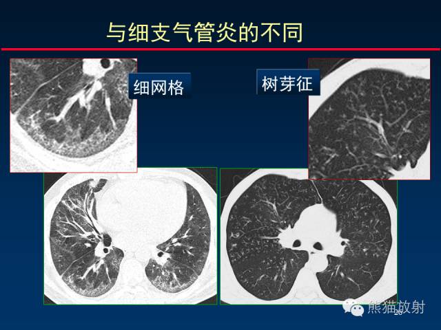 【PPT】肺内间质改变的基本CT征象