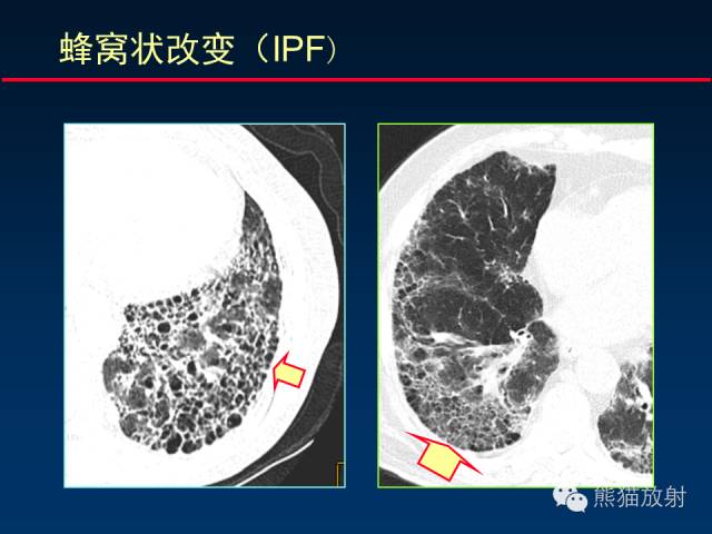 【PPT】肺内间质改变的基本CT征象