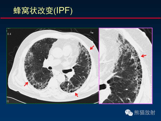 【PPT】肺内间质改变的基本CT征象