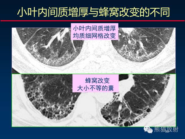 【PPT】肺内间质改变的基本CT征象