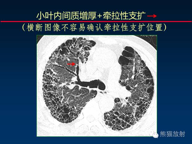 【PPT】肺内间质改变的基本CT征象